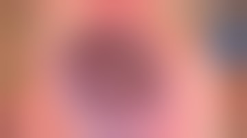 MASTERING  PHACOEMULSIFICATION, CHOPPING, THE ART :STOP AND CHOP