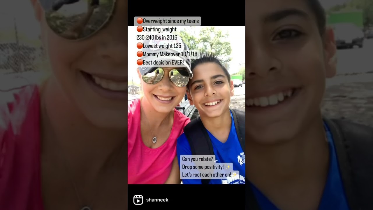 Body Lift Surgery - Before and After