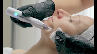 TÉCNICA TKN COLLAGEN INDUCTION PEN | TOSKANI