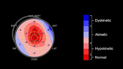 Interpreting the bulls eye plot in speckle tracking echocardiography