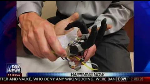 Charlotte Surgeons Complete First Prosthetic Hand ...