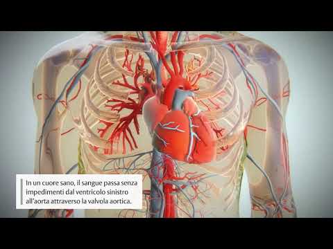 Video: Come Trovare la Causa del Rigurgito Aortico: 11 Passaggi