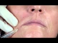 Lip Lifting & getting rid of Marionette Lines - YouTube