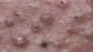Best Blackhead Removal Ever 55min - Facial Acne Treatment