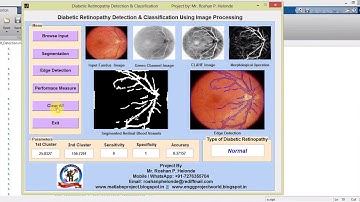 Matlab Code For Diabetic Retinopathy Detection in Fundus Image Using Image Processing