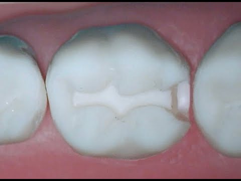 #30 DO Composite Preparation