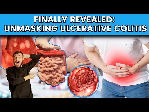 Video: Scientists have finally discovered how the ulcerative colitis drug works