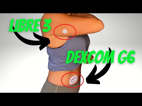 Dexcom G6 OR Freestyle Libre 3  – Which one is best?