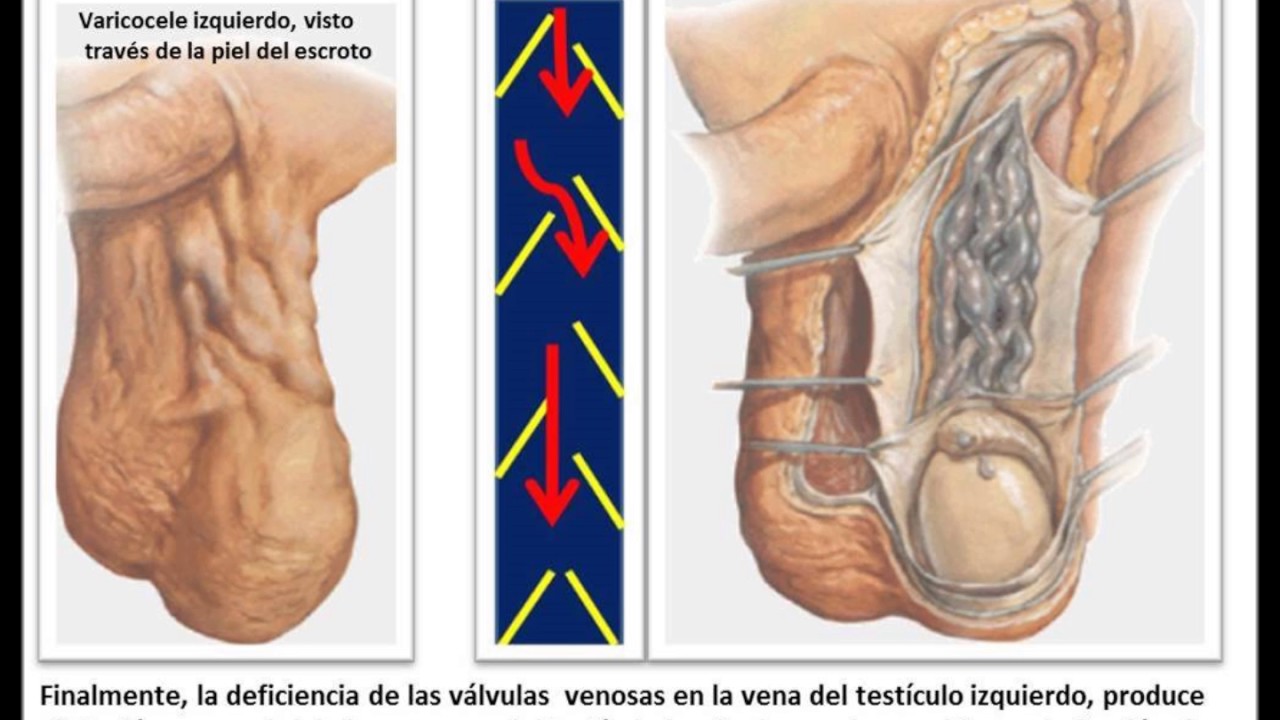 Mesoterapia din vene varicoase. Mesoterapia din vene varicoase