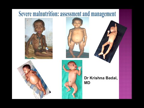 Video: Hypotrophy - Degrees, Fetal Malnutrition, Muscle Wasting In Children