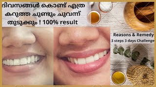 Lip Darkness ഇന നസരമയ മററയടകകRoughblack Lips To Softred In 3 Dayshome Remedyvlog27