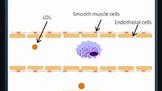 Atherosclerosis