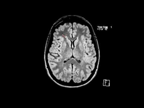 MS white matter lesions
