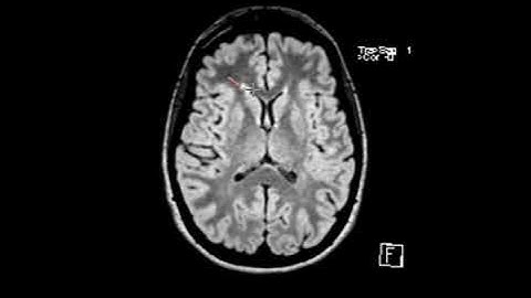 MS white matter lesions | First Look MRI