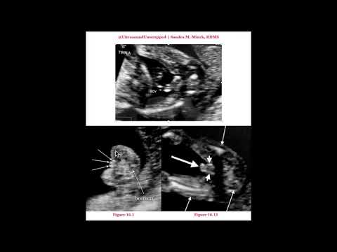 Video: Pwede bang 3 lines sa ultrasound ang ibig sabihin ng boy?