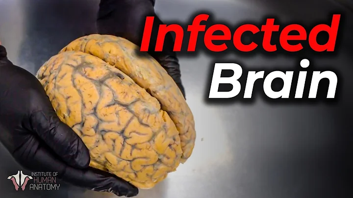 Rabies: One of the Most Deadly Viruses