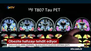 Obezite Hafızayı Da Tehdit Ediyor İrlandalı Bilim Insanlarından Uyarı