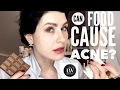 Food and acne connection - Is it a myth or a fact that food can cause acne? Dr. Liv explains