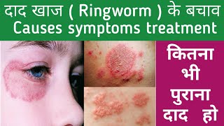 दाद का इलाज | Ringworm Treatment in hindi | Ringworm Best Medicine | Causes, symptoms, Treatment