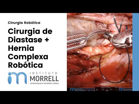 Diastase de Reto Abdominal / Cirurgia Robotica de Hernia e Diastase - Estetica