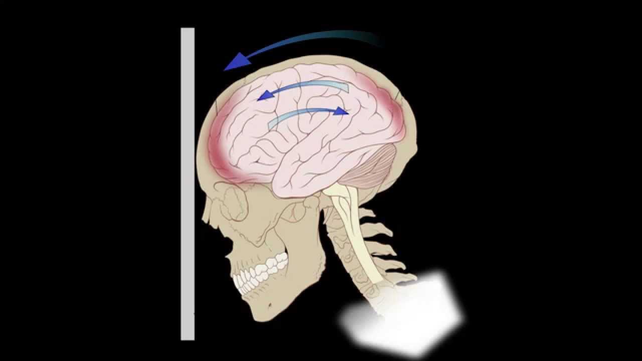 Common Brain Injuries: Coup-contracoup - YouTube tbi head diagram 