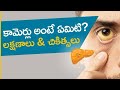 Jaundice Definition/causes /types