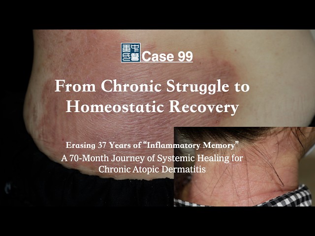 Systemic Regulation and Homeostatic Reconstruction in Chronic Atopic Dermatitis