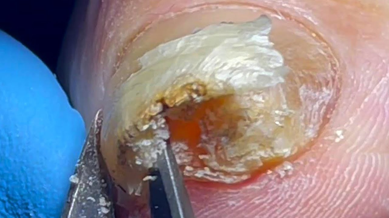 Невероятно завитые ногти, вырывание толстых вросших ногтей【Мастер педикюра Линь Цзюнь】