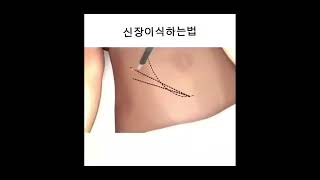 신장 이식하는 법 #shorts