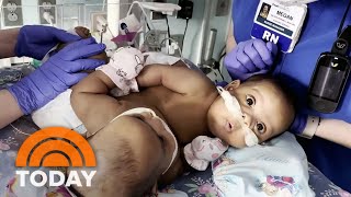 Conjoined twins successfully separated in rare surgery