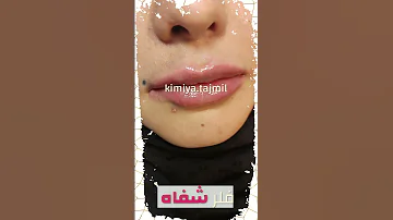 فيلر الشفايف Lip Fillers 