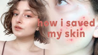 how i saved my skin from adult acne (+current skin care routine) || epiduo review & side effects