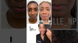 Before and after under eye filler black woman, tired eyes, nonsurgical bleph, eye lift, rid eye bags