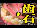 歯医者かおり「歯石がついてるか判断のコツ？　〇〇したら一撃でわかります」