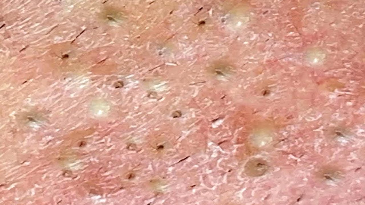 Deep Blackhead Extraction Cystic Acne And Pimple Popping 57 Youtube