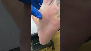 Get Ready For Satisfying Relief! Watch An Australian Podiatrist Work Miracles On Thick Calluses. #Po
