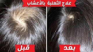 كيفية علاج مرض ثعلبة الشعر بالاعشاب الطبيعية نهائيا؟