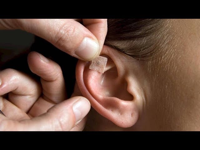Auriculoterapia para adelgazar puntos premiadores