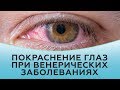 Покраснение глаз при венерических заболеваниях
