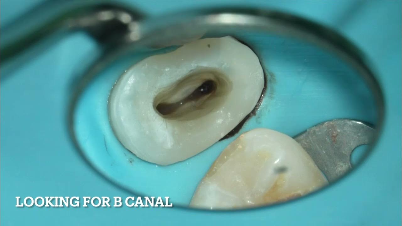 Removing overfilled gutta percha from a perforated area YouTube