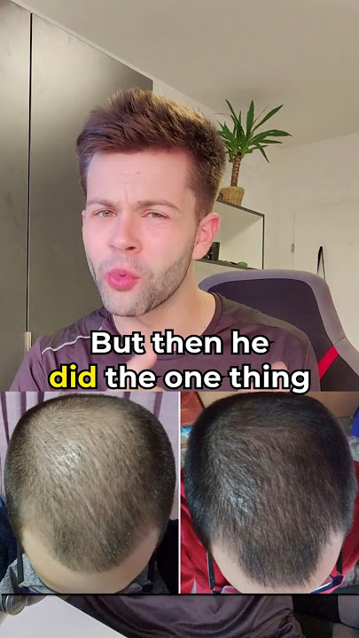 This is what happens if you STOP Minoxidil #hair #minoxidil #hairlosstreatment