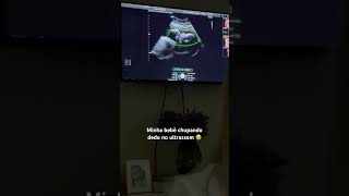 Minha Bebê Chupando Dedo No Ultrom