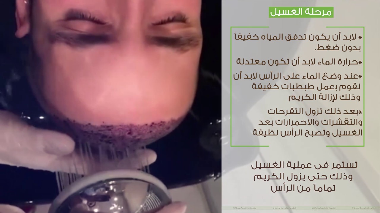 مركز زراعة الشعر في السعودية مستشفى الموسى التخصصي