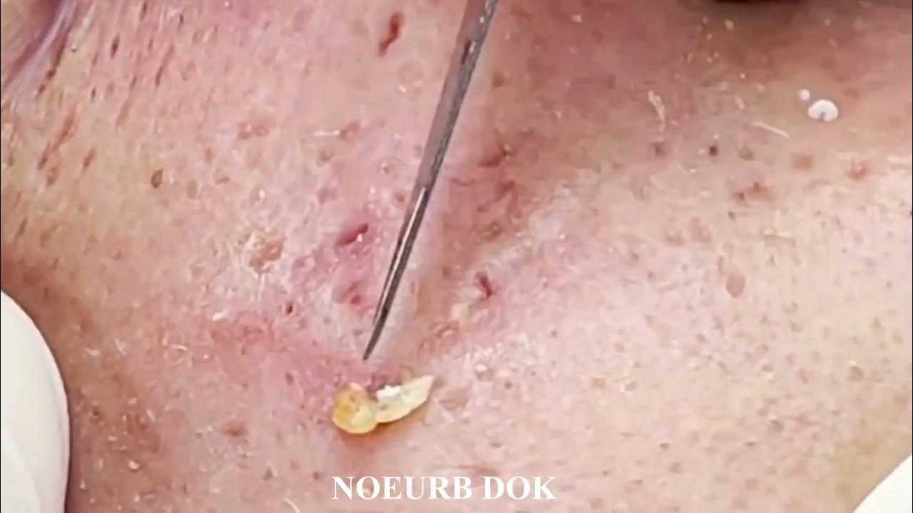 😱Popping huge blackheads and Pimple Popping Best Pimple Popping videos😱