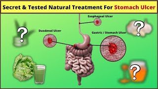 5 Secret & Tested Best Foods To Cure Stomach Ulcer | Stomach Ulcer Symptoms And Treatment