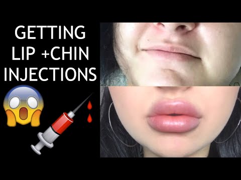 WATCH ME GET LIP INJECTIONS | Anna Paul 