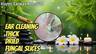 Another Common Example of Ear Cleaning thick dried fungal slices Earwax Removing #044