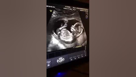 IVF #1 cykeln; Del 13. Gravid! Det andra Ultraljudet i v 16 (15+6)