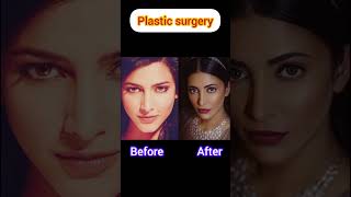 plastic surgery in Bollywood, before after photos..shortsviral  plasticsurgeryindia