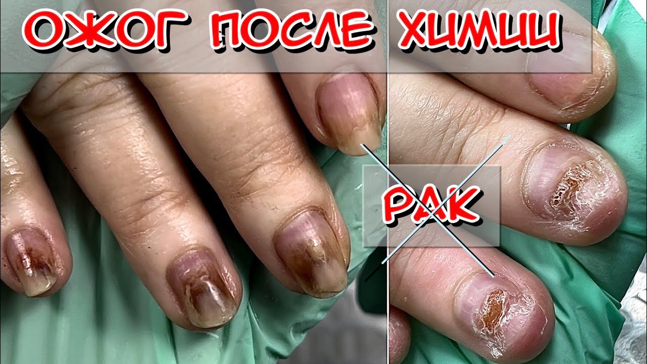 Ожог ногтей после химиотерапии / Ногти после рака / Ногти после химии ...